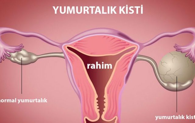 Yumurtalık Kisti Sandığınız Şey Aslında Yumurtlama Olabilir mi? Yumurtalık Kisti Sandığınız Şey Aslında Yumurtlama Olabilir mi?