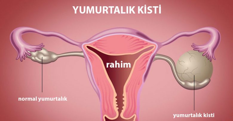 Yumurtalık Kisti Sandığınız Şey Aslında Yumurtlama Olabilir mi?
